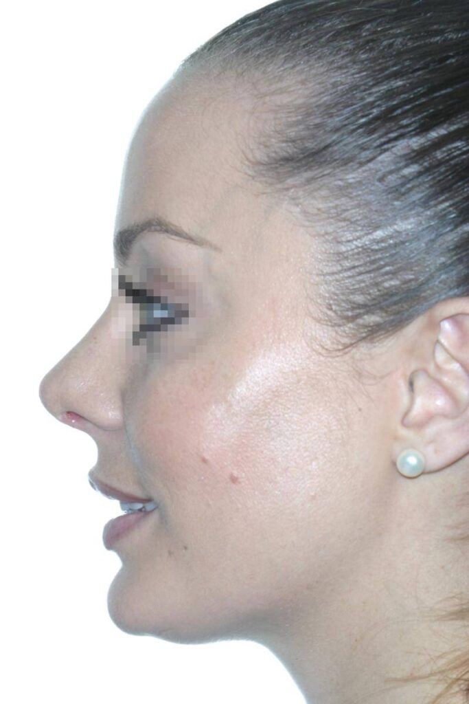 Caso Clínico Rinoplastia​