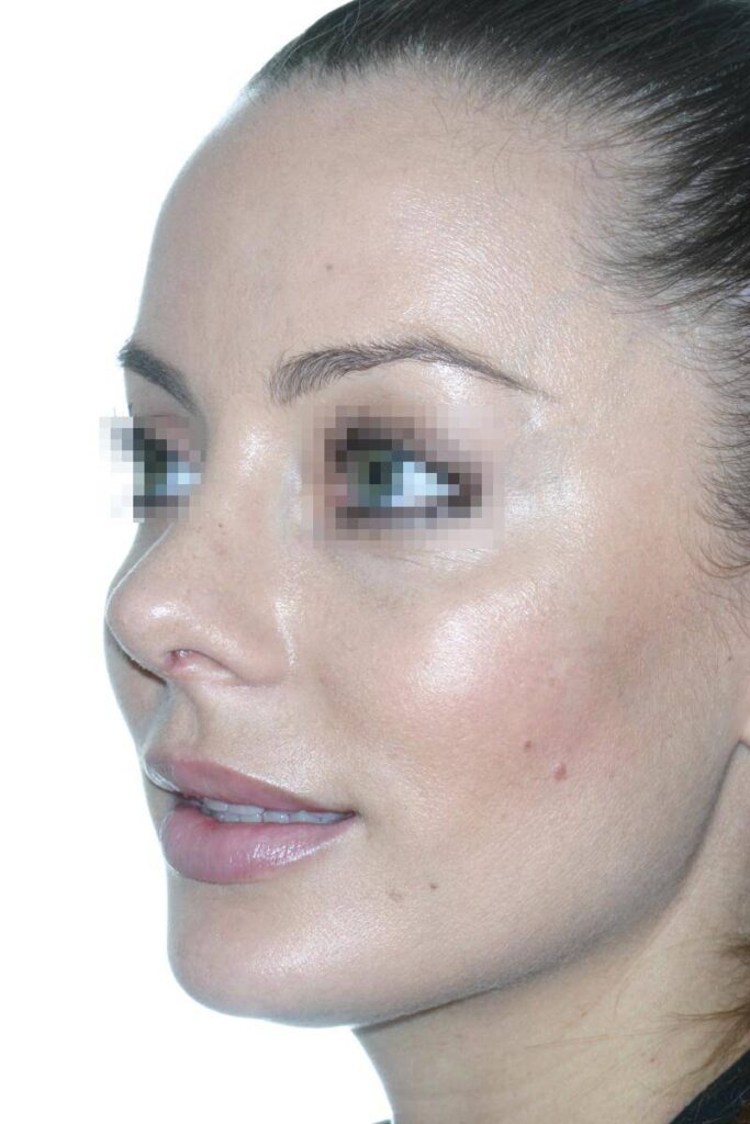 Caso Clínico Rinoplastia​