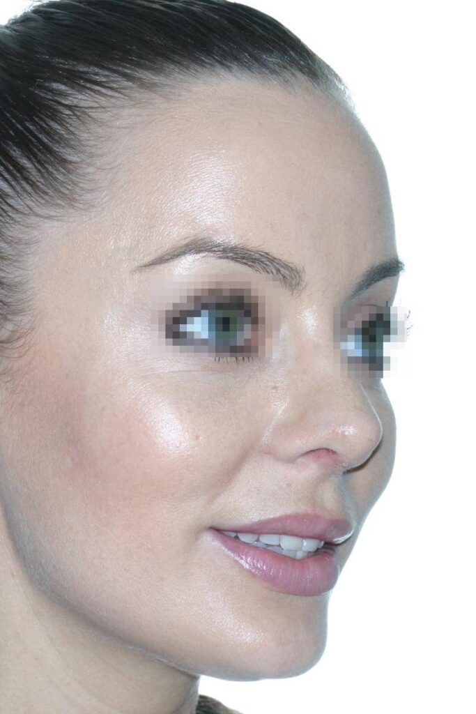 Caso Clínico Rinoplastia​