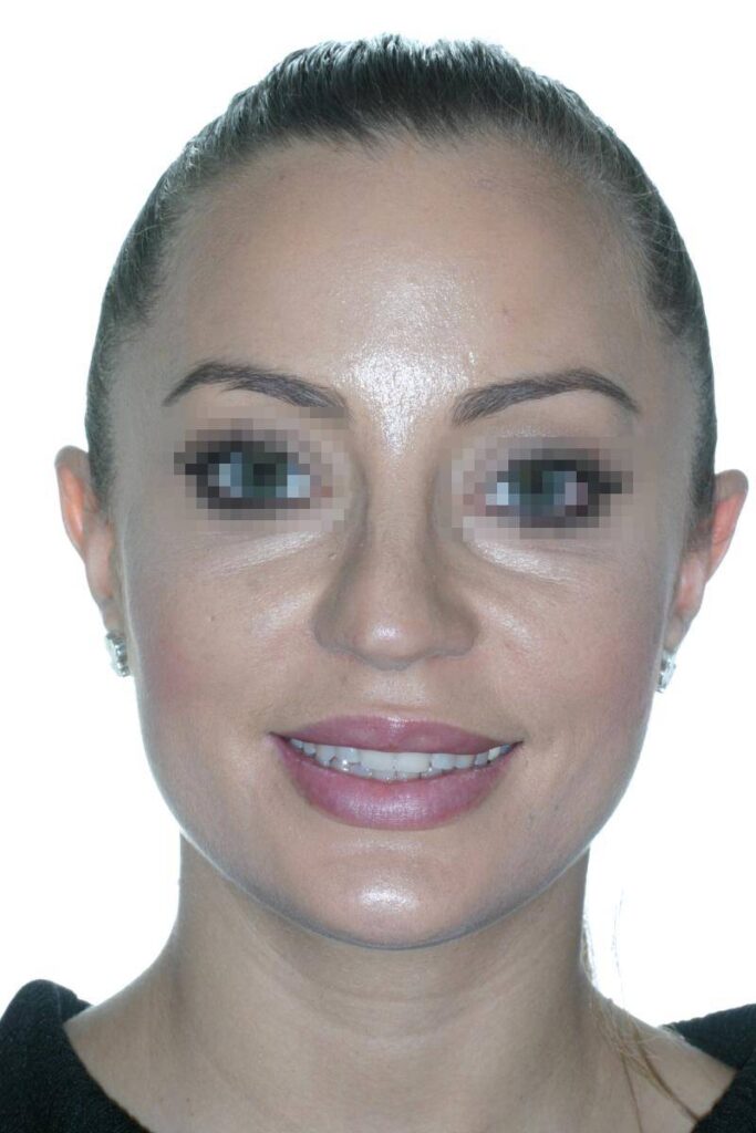 Caso Clínico Rinoplastia​