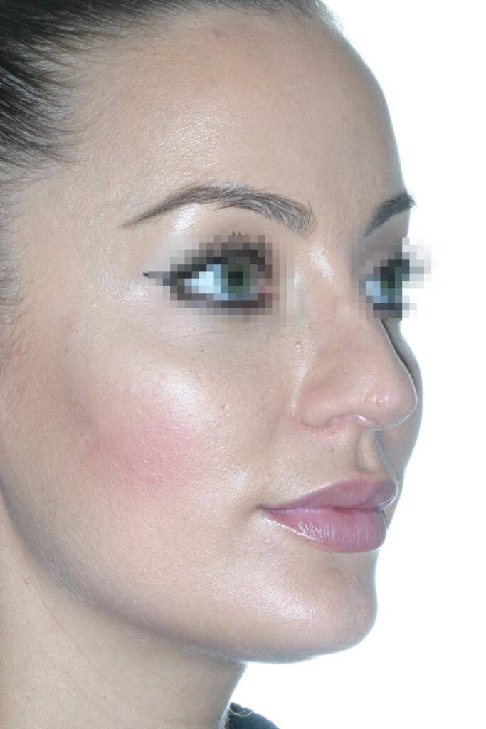 Caso Clínico Rinoplastia​