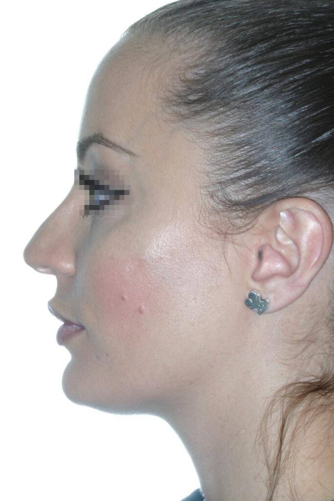 Caso Clínico Rinoplastia​