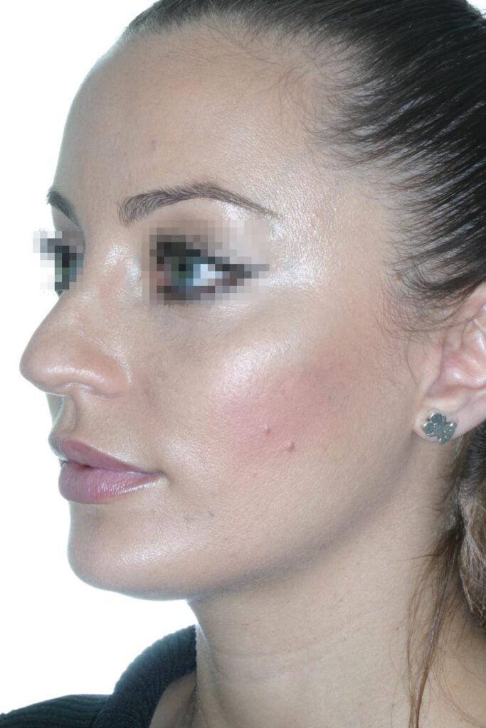 Caso Clínico Rinoplastia​