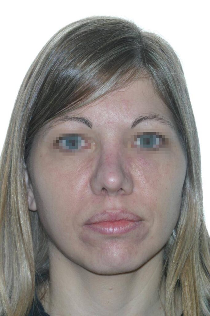 Caso Clínico Rinoplastia​