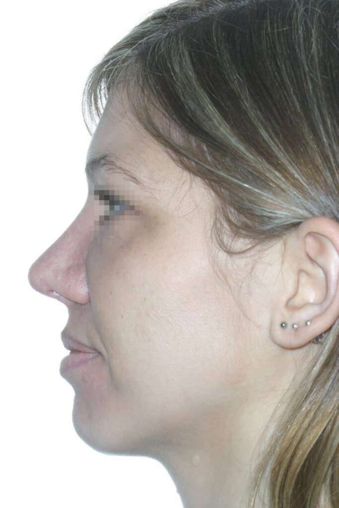 Caso Clínico Rinoplastia​