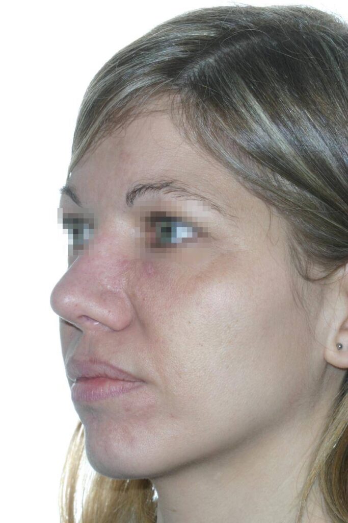 Caso Clínico Rinoplastia​