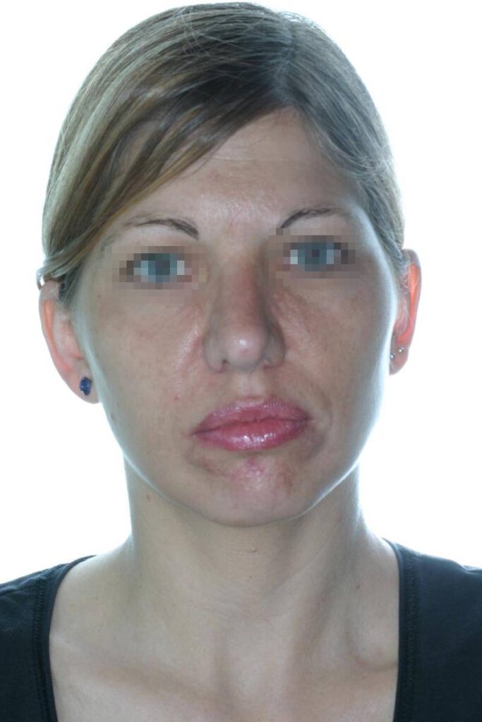 Caso Clínico Rinoplastia​