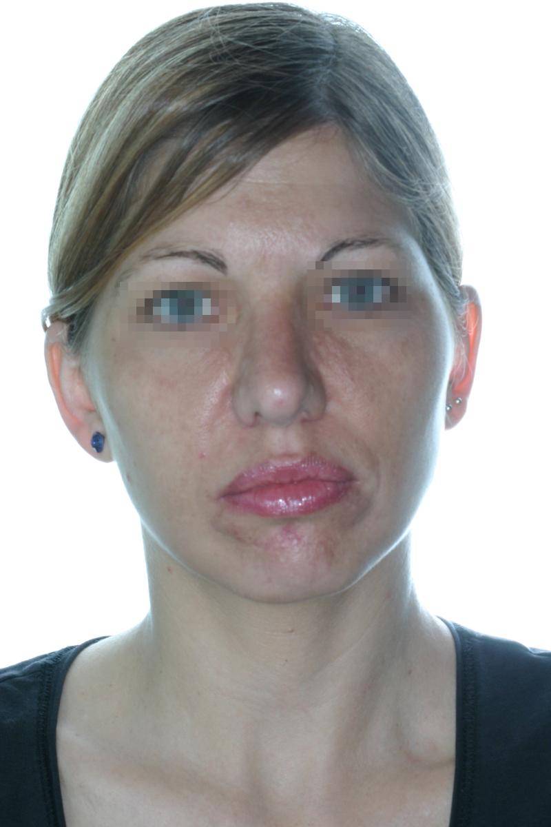 Rhinoplasty: correction of nasal dorsum and bulbous tip - Birbe Clinic ...