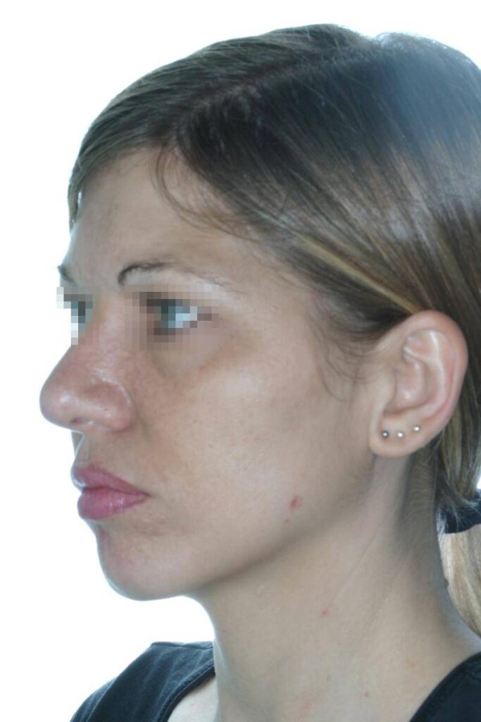 Caso Clínico Rinoplastia​