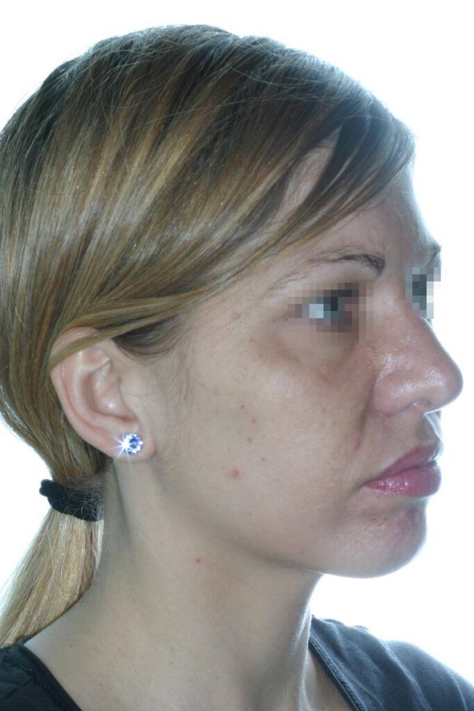 Caso Clínico Rinoplastia​