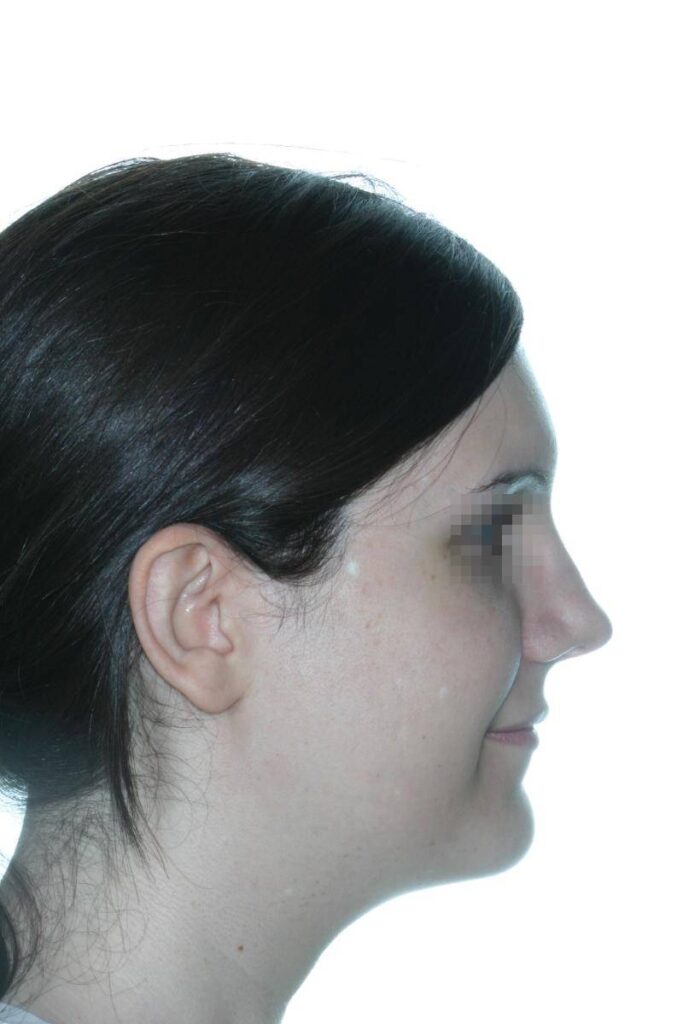 Caso Clínico Rinoplastia​