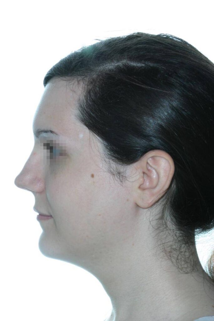 Caso Clínico Rinoplastia​