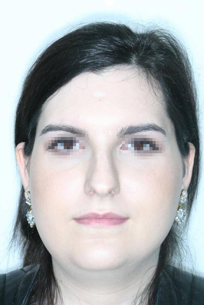 Caso Clínico Rinoplastia​