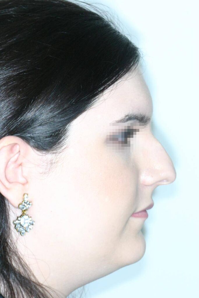 Caso Clínico Rinoplastia​