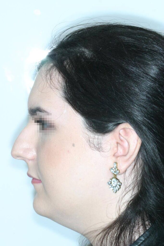 Caso Clínico Rinoplastia​