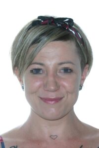 Caso Clínico Rinoplastia