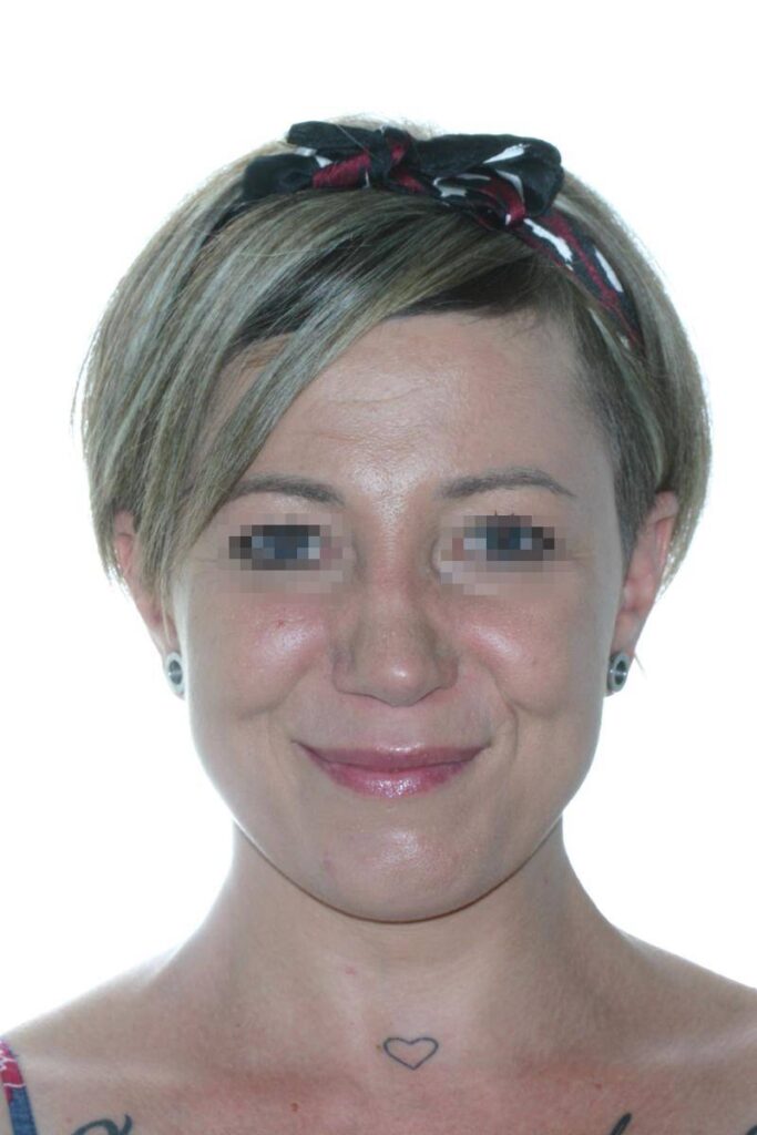 Caso Clínico Rinoplastia