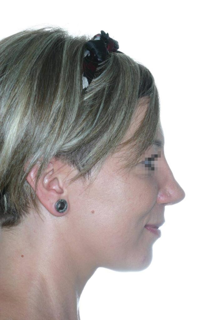 Caso Clínico Rinoplastia