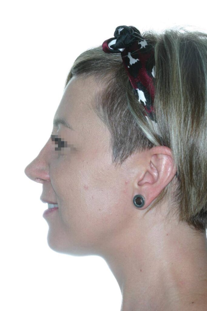 Caso Clínico Rinoplastia