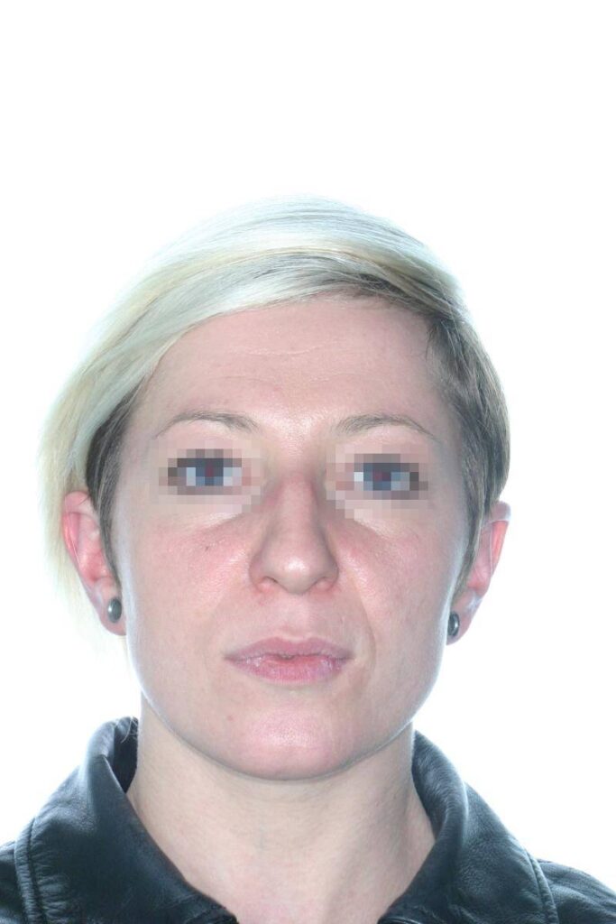 Caso Clínico Rinoplastia