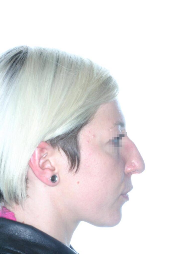 Caso Clínico Rinoplastia