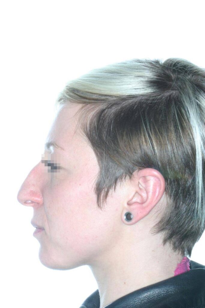 Caso Clínico Rinoplastia