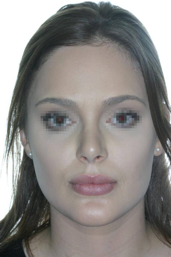 Caso Clínico Rinoplastia