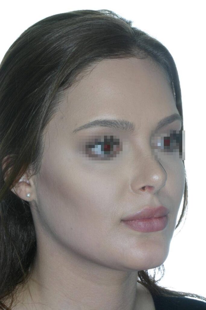 Caso Clínico Rinoplastia