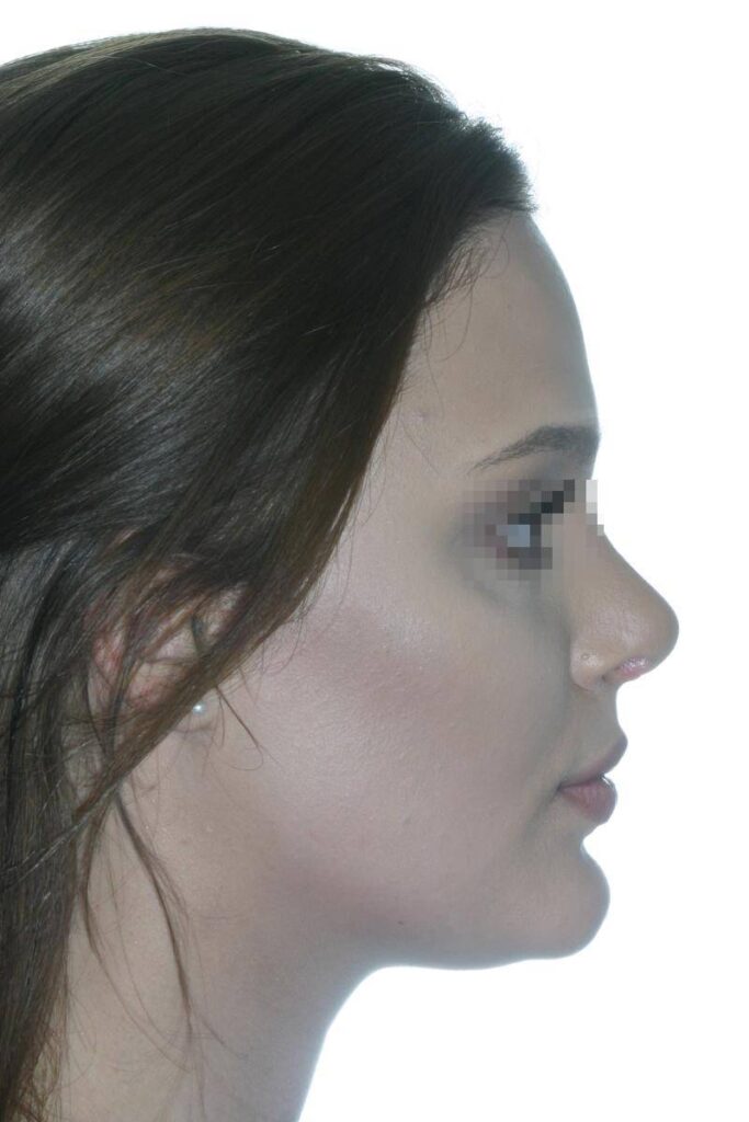 Caso Clínico Rinoplastia