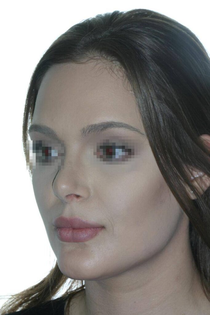 Caso Clínico Rinoplastia