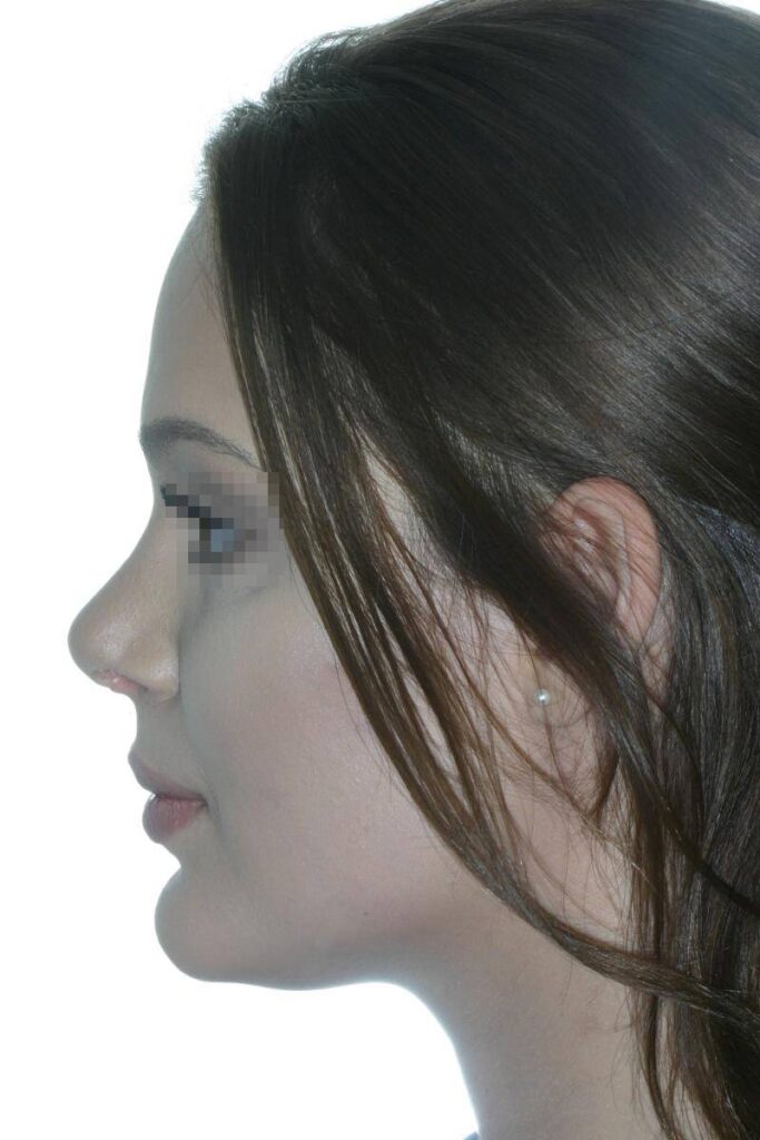 Caso Clínico Rinoplastia