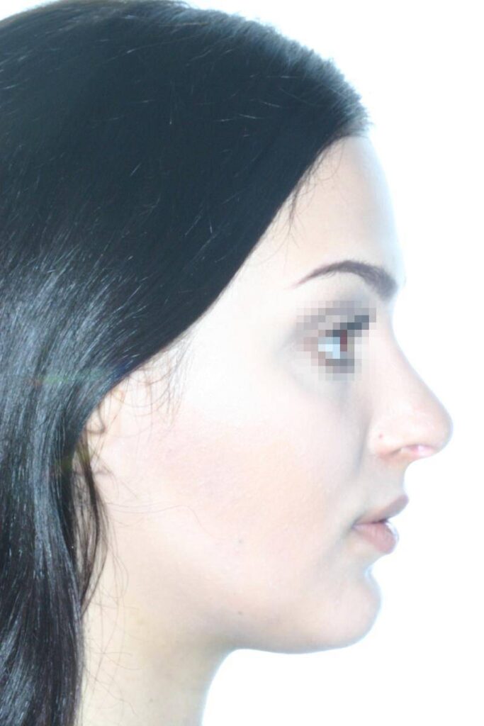 Caso Clínico Rinoplastia