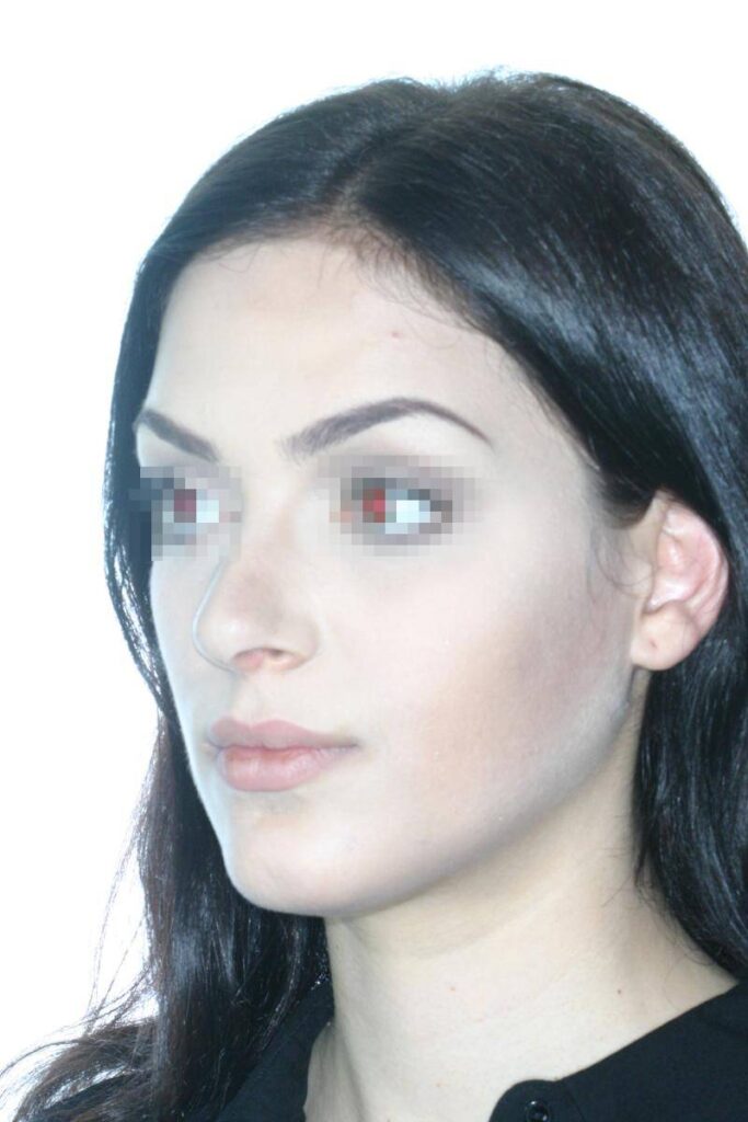 Caso Clínico Rinoplastia