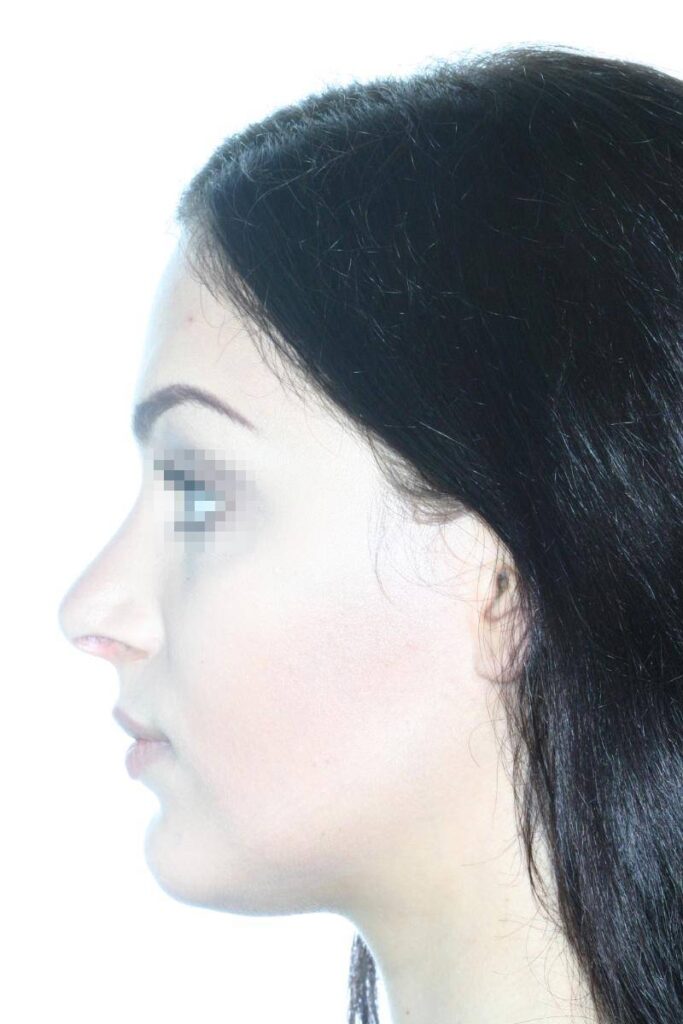 Caso Clínico Rinoplastia