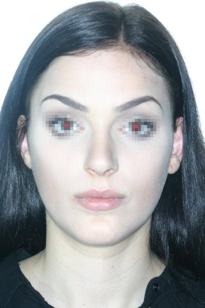 Caso Clínico Rinoplastia