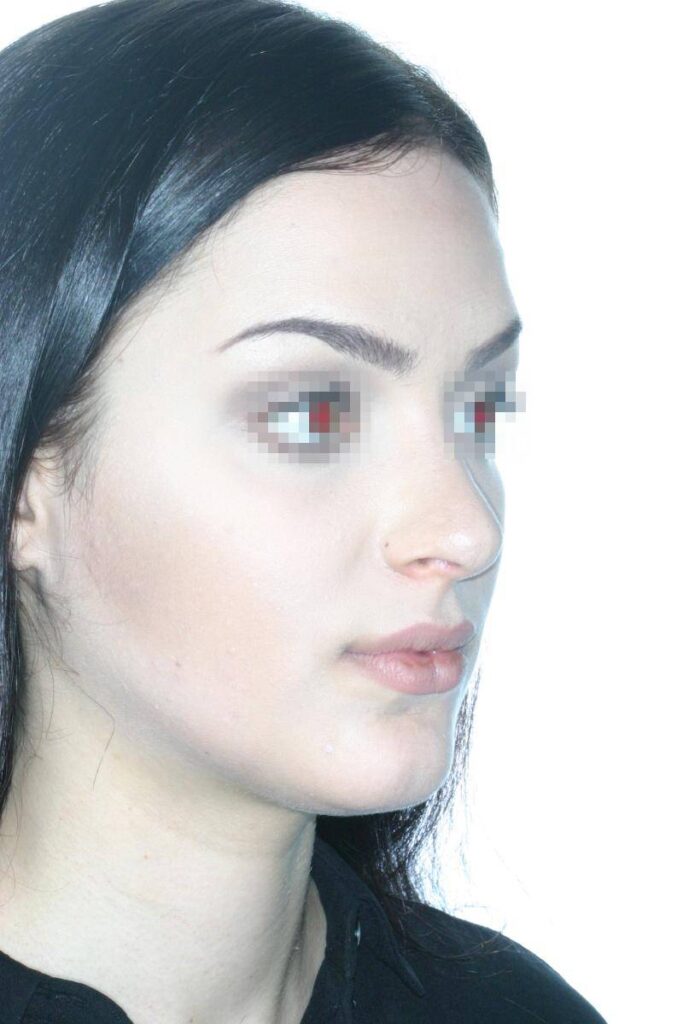 Caso Clínico Rinoplastia