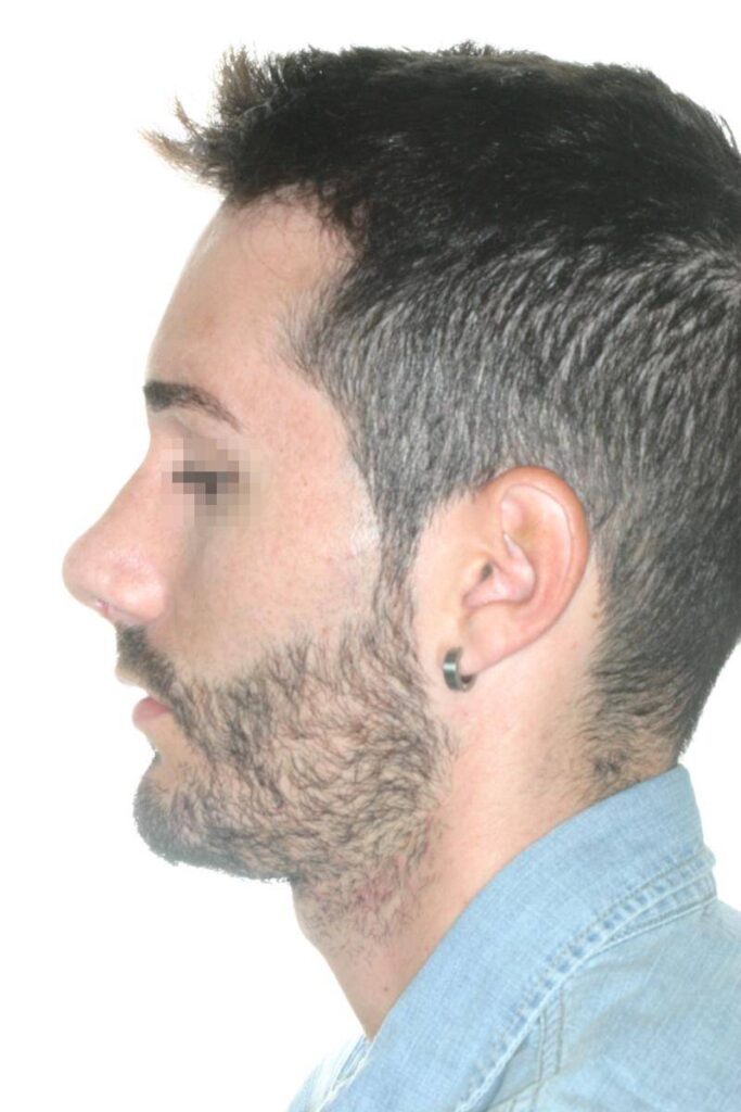 Caso Clínico Rinoplastia​