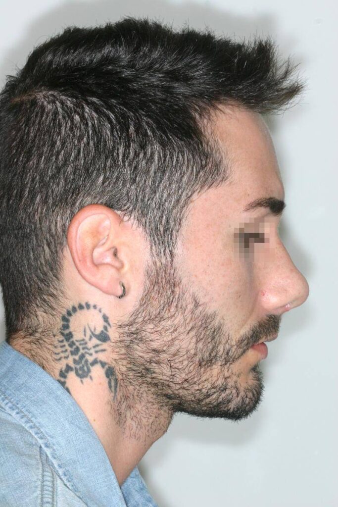 Caso Clínico Rinoplastia​