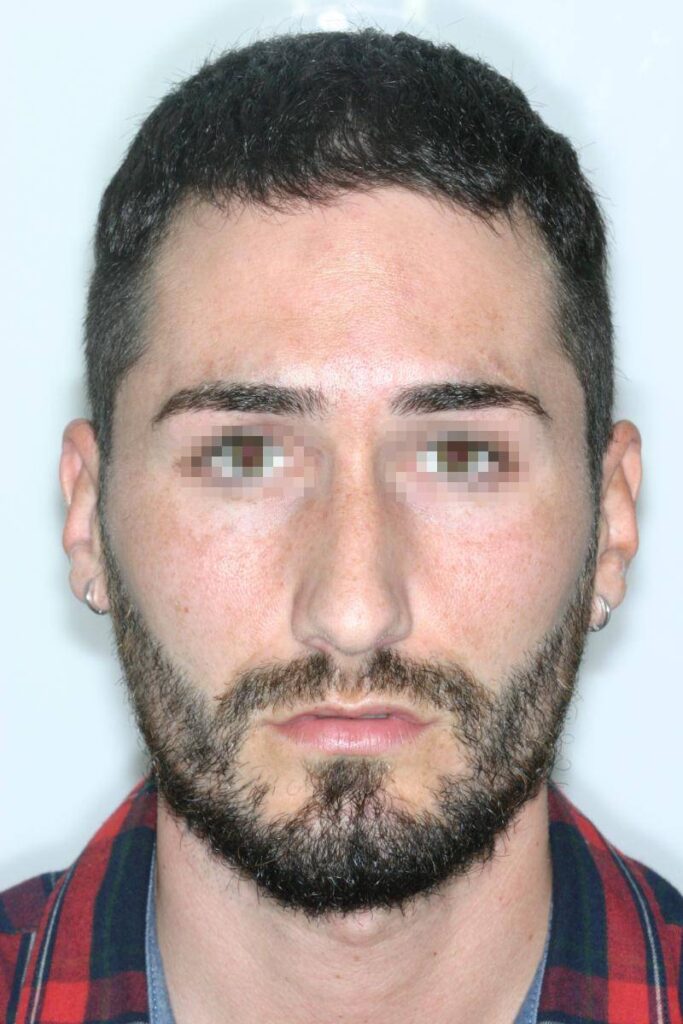 Caso Clínico Rinoplastia​