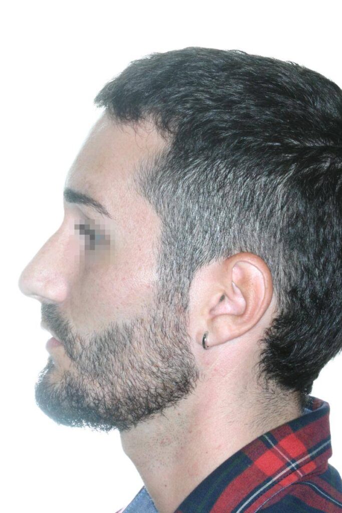 Caso Clínico Rinoplastia​