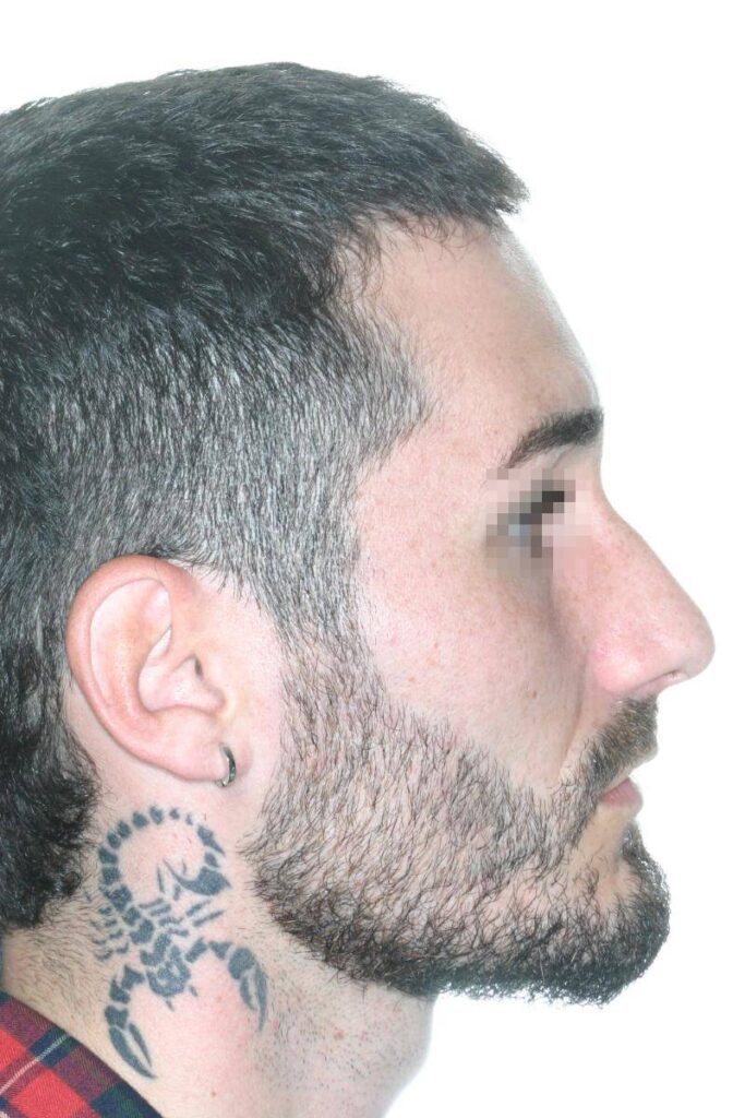 Caso Clínico Rinoplastia​