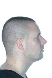 Caso Clínico Rinoplastia​