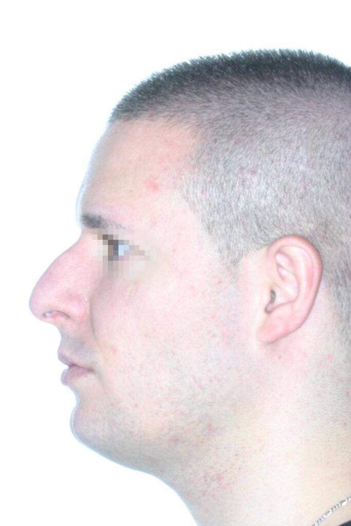 Caso Clínico Rinoplastia​