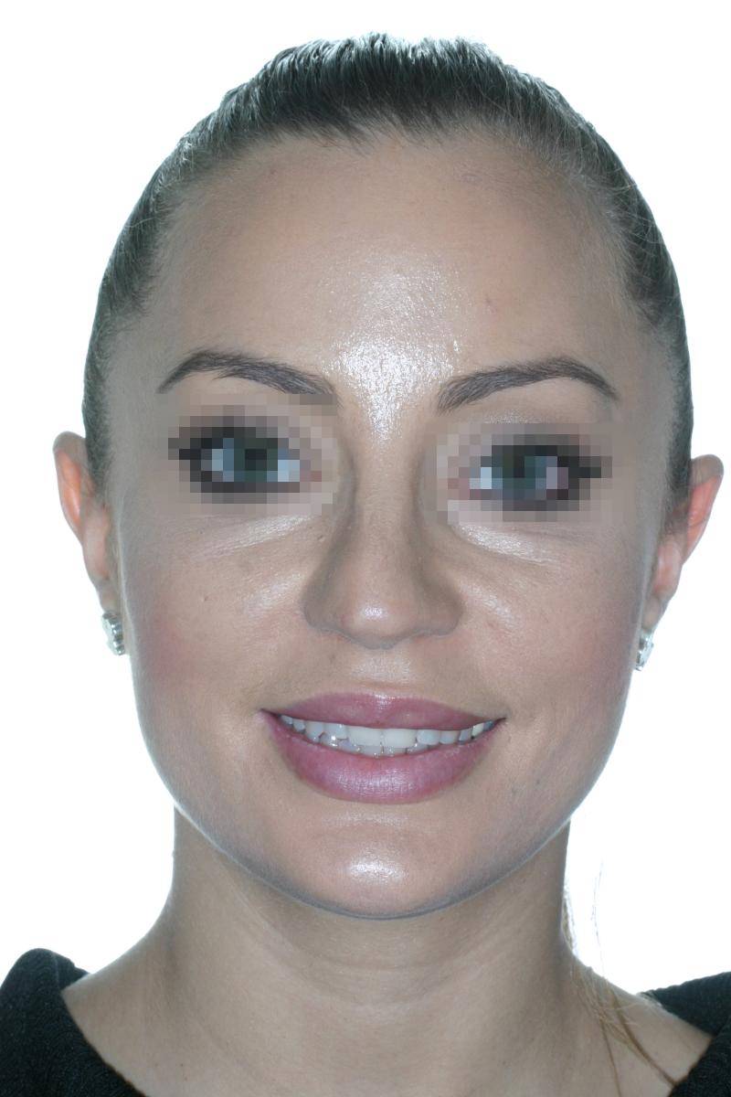 Facial harmonization rhinoplasty: balance and naturalness - Birbe ...