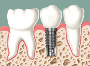 Implante-dental