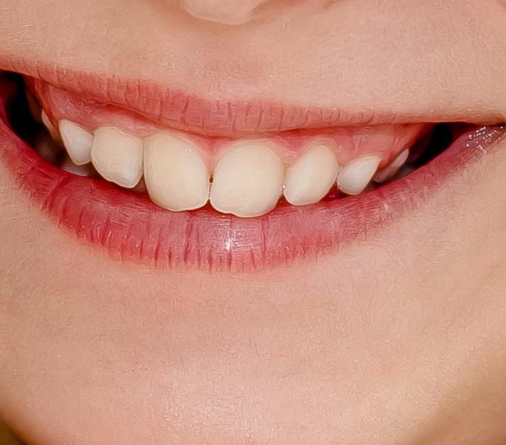 diente fisura