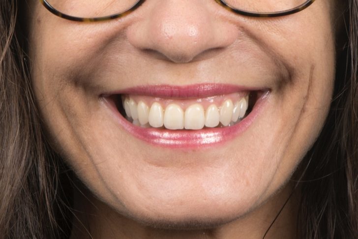 Caso clínico carillas dentales