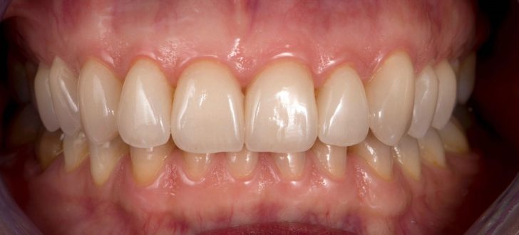 Caso clínico carillas dentales