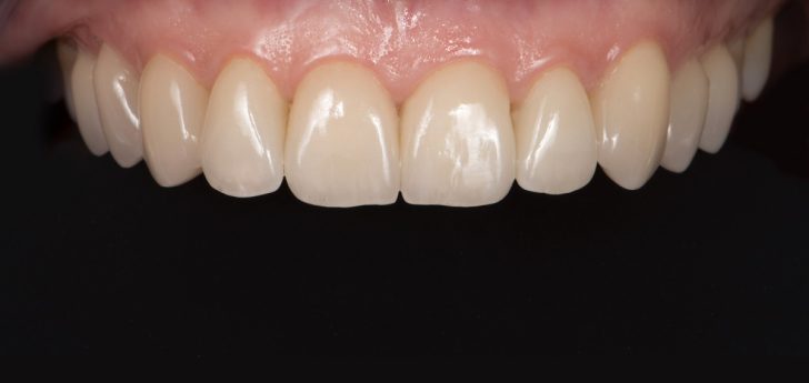 Caso clínico carillas dentales