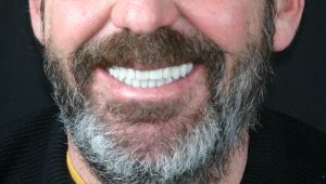 Caso clínico carillas dentales